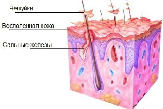Как образуются чешуйки на коже головы